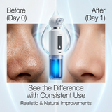 PurePore™ Aqua Vacuum Blackhead Remover